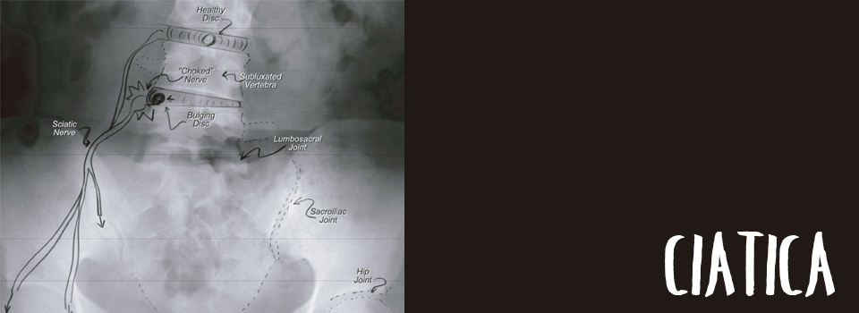 Ciática