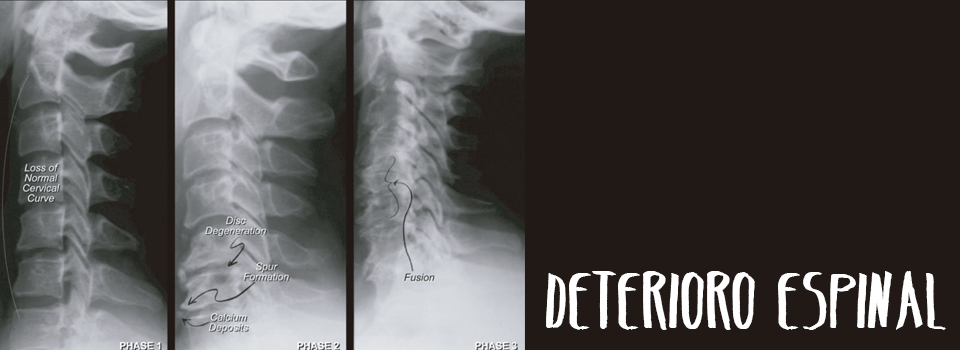 Deterioro espinal