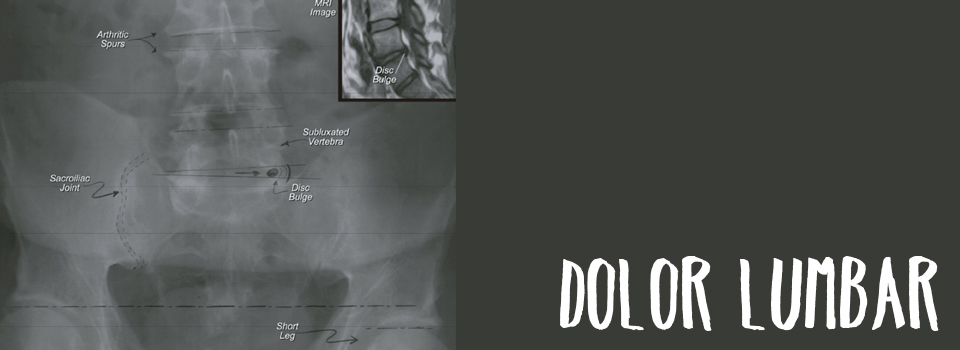 Dolor lumbar