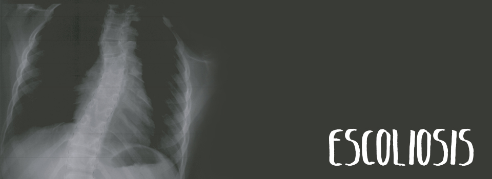 Escoliosis