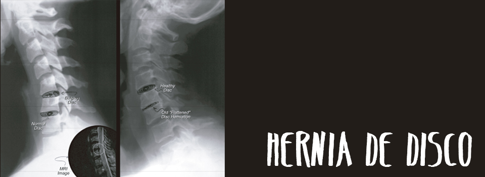Hernia de disco